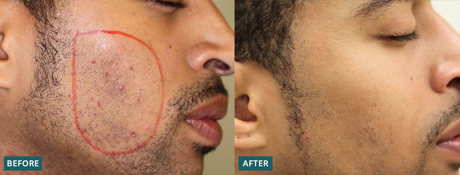 Ingrown Hairs | Dermatology & Laser Surgery Center