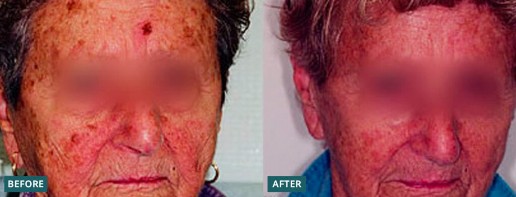 Sun Damage Lesions